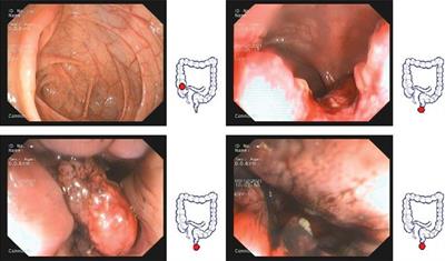 Pathologic complete response to TNT + camrelizumab for rectal cancer with surgical anus-preservation: case report and literature review